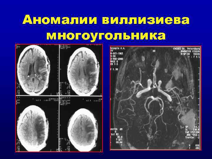 Аномалии виллизиева многоугольника 