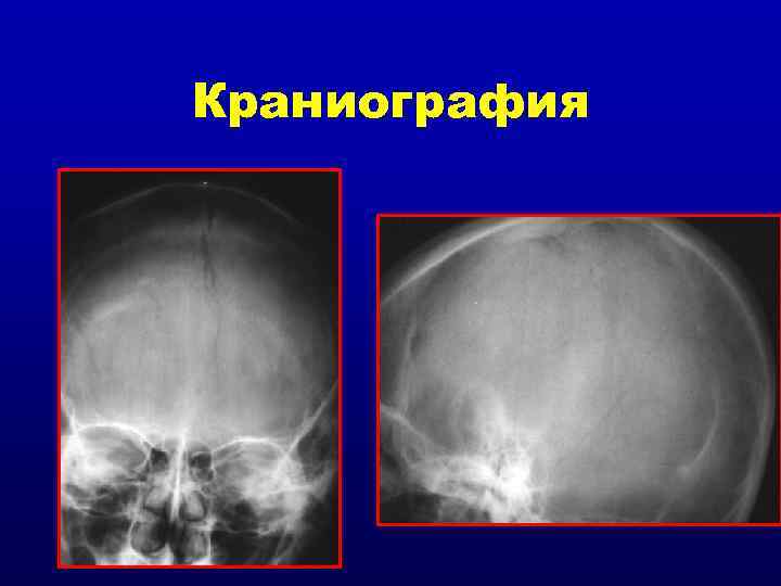 Краниография 