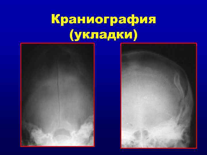 Краниография (укладки) 