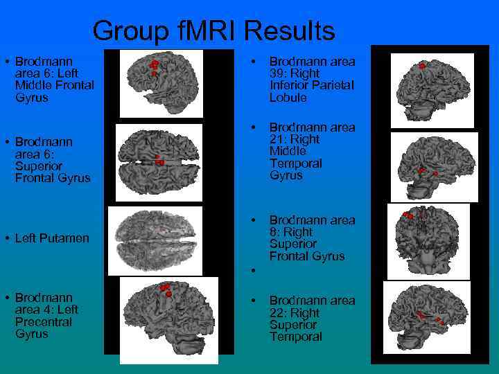 Group f. MRI Results • Brodmann area 6: Left Middle Frontal Gyrus • Brodmann
