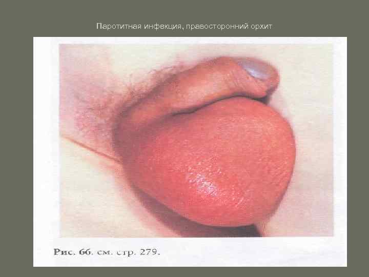 Паротитная инфекция, правосторонний орхит 