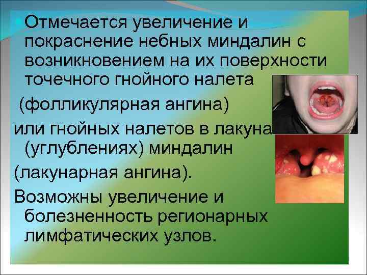  Отмечается увеличение и покраснение небных миндалин с возникновением на их поверхности точечного гнойного