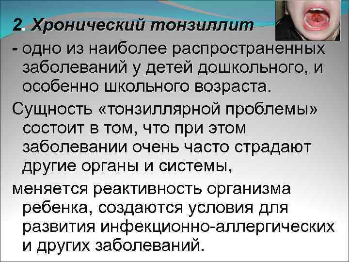 2. Хронический тонзиллит - одно из наиболее распространенных заболеваний у детей дошкольного, и особенно