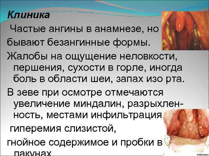 Клиника Частые ангины в анамнезе, но бывают безангинные формы. Жалобы на ощущение неловкости, першения,