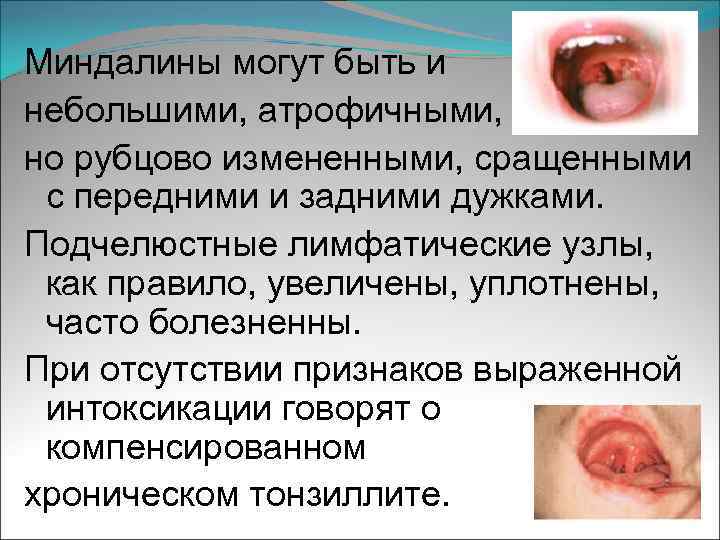 Миндалины могут быть и небольшими, атрофичными, но рубцово измененными, сращенными с передними и задними