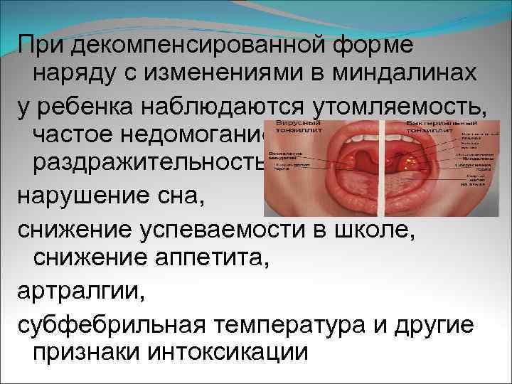 При декомпенсированной форме наряду с изменениями в миндалинах у ребенка наблюдаются утомляемость, частое недомогание,