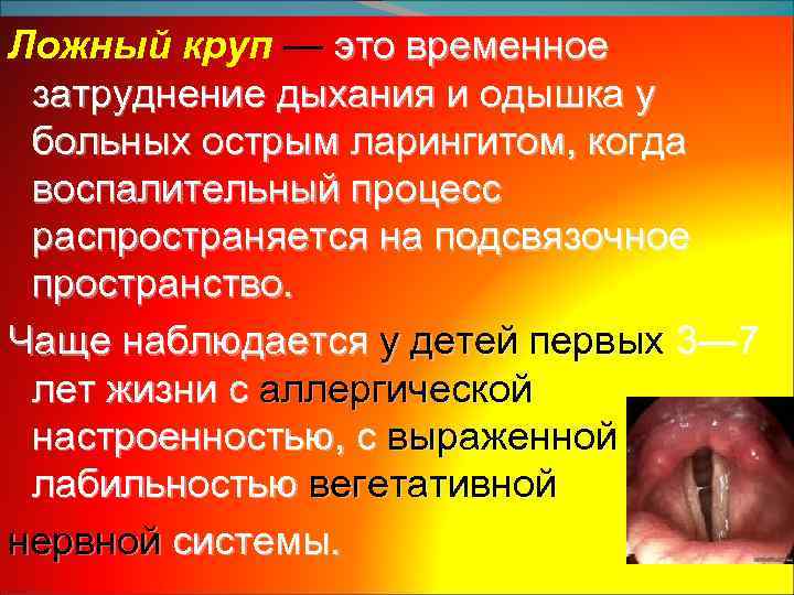 Ложный круп — это временное затруднение дыхания и одышка у больных острым ларингитом, когда