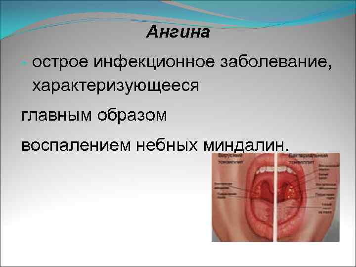 Ангина - острое инфекционное заболевание, характеризующееся главным образом воспалением небных миндалин. 