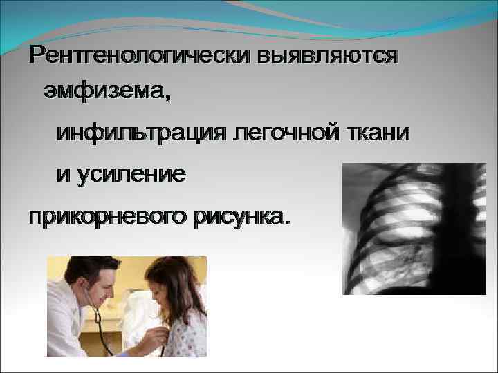 Рентгенологически выявляются эмфизема, инфильтрация легочной ткани и усиление прикорневого рисунка. 