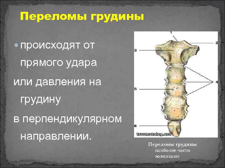 Перелом грудины