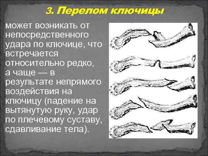 3. Перелом ключицы может возникать от непосредственного удара по ключице, что встречается относительно редко,