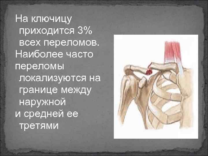 На ключицу приходится 3% всех переломов. Наиболее часто переломы локализуются на границе между наружной