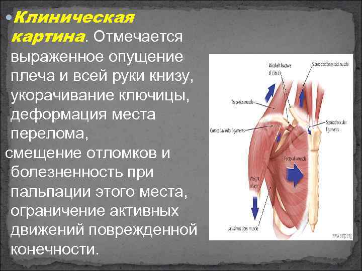  Клиническая картина. Отмечается выраженное опущение плеча и всей руки книзу, укорачивание ключицы, деформация