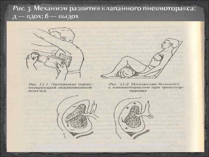 Рис. 3. Механизм развития клапанного пневмоторакса: д — вдох; 6 — выдох 