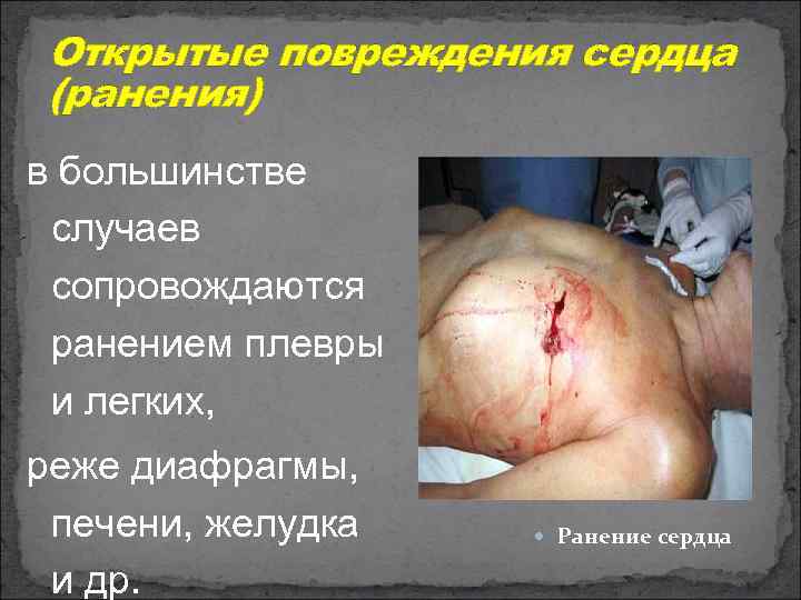 Открытые повреждения сердца (ранения) в большинстве случаев сопровождаются ранением плевры и легких, реже диафрагмы,