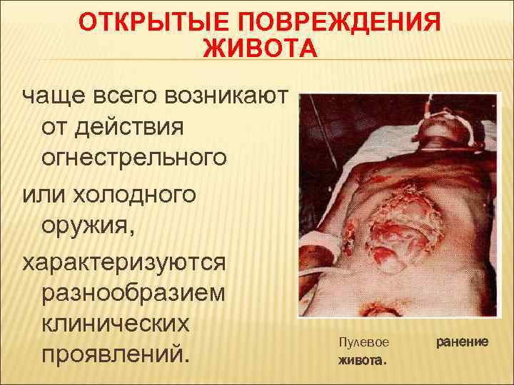 ОТКРЫТЫЕ ПОВРЕЖДЕНИЯ ЖИВОТА чаще всего возникают от действия огнестрельного или холодного оружия, характеризуются разнообразием