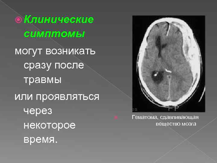 Черепно мозговые гематомы. Клинический симптом травмы головы. Сдавленивание вещества мозга. Ушиб головного мозга средней степени.