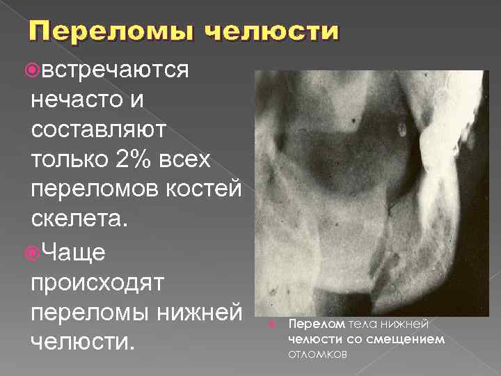 Переломы челюсти встречаются нечасто и составляют только 2% всех переломов костей скелета. Чаще происходят