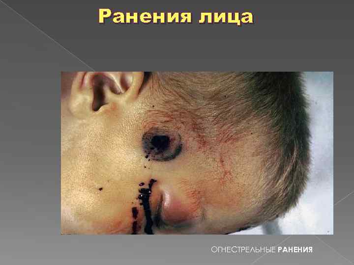 Ранения лица ОГНЕСТРЕЛЬНЫЕ РАНЕНИЯ 