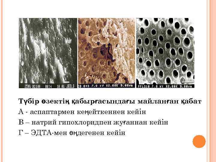 Түбір өзектің қабырғасындағы майланған қабат А - аспаптармен кеңейткеннен кейін В – натрий гипохлоридпен