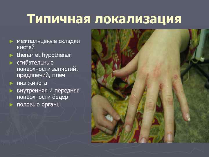 Типичная локализация ► ► ► межпальцевые складки кистей thenar et hypothenar сгибательные поверхности запястий,