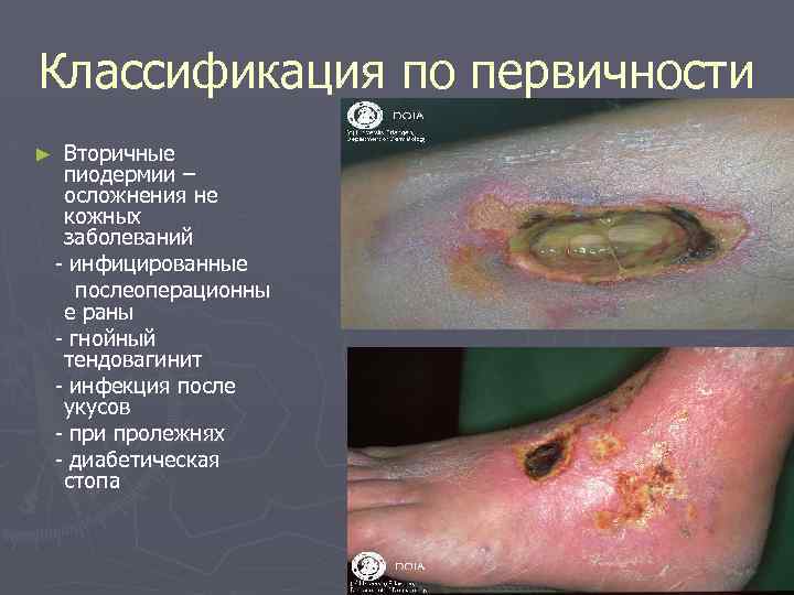 Классификация по первичности ► Вторичные пиодермии – осложнения не кожных заболеваний - инфицированные послеоперационны