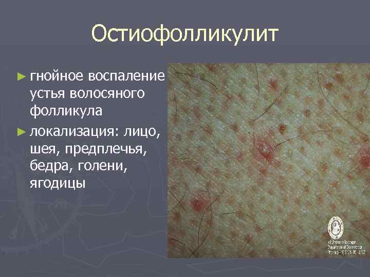 Остиофолликулит ► гнойное воспаление устья волосяного фолликула ► локализация: лицо, шея, предплечья, бедра, голени,