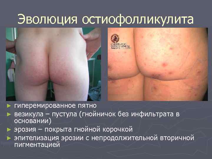 Эволюция остиофолликулита гиперемированное пятно везикула – пустула (гнойничок без инфильтрата в основании) ► эрозия