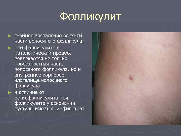 Фолликулит гнойное воспаление верхней части волосяного фолликула. ► при фолликулите в патологический процесс вовлекается