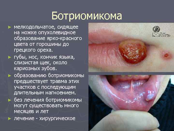 Ботриомикома ► ► ► мелкодольчатое, сидящее на ножке опухолевидное образование ярко-красного цвета от горошины