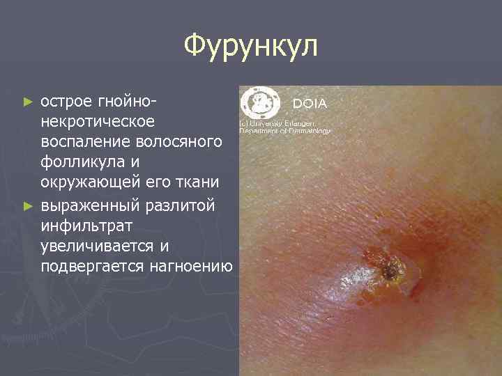 Фурункул острое гнойнонекротическое воспаление волосяного фолликула и окружающей его ткани ► выраженный разлитой инфильтрат