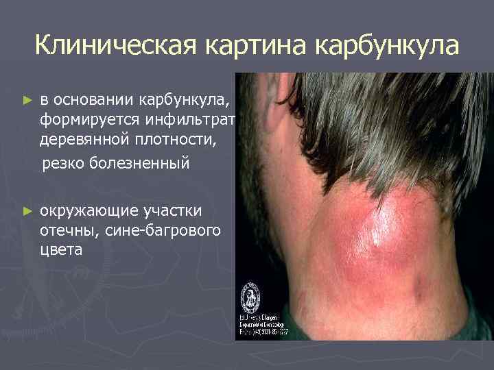 Клиническая картина карбункула ► в основании карбункула, формируется инфильтрат деревянной плотности, резко болезненный ►