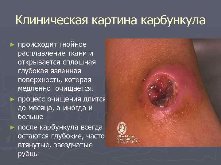 Клиническая картина карбункула происходит гнойное расплавление ткани и открывается сплошная глубокая язвенная поверхность, которая