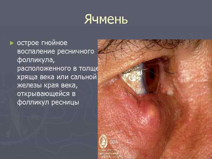 Ячмень ► острое гнойное воспаление ресничного фолликула, расположенного в толще хряща века или сальной
