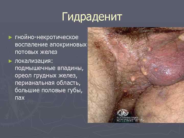 Гидраденит гнойно-некротическое воспаление апокриновых потовых желез ► локализация: подмышечные впадины, ореол грудных желез, перианальная
