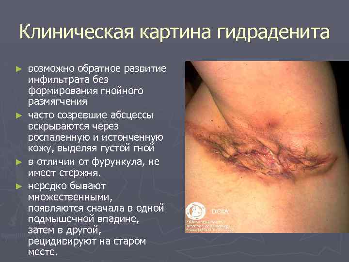 Клиническая картина гидраденита ► ► возможно обратное развитие инфильтрата без формирования гнойного размягчения часто