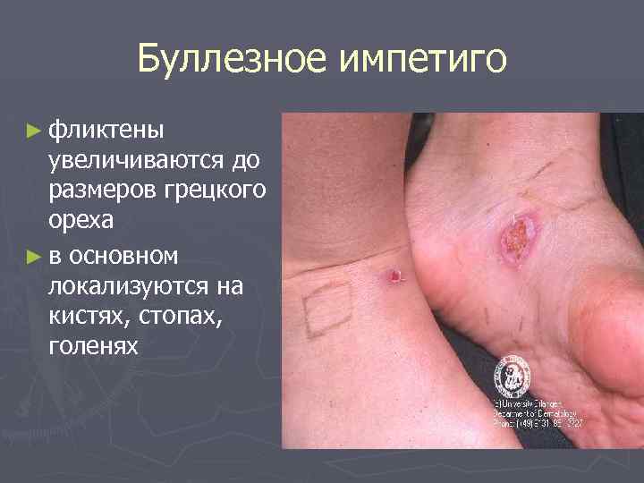 Буллезное импетиго ► фликтены увеличиваются до размеров грецкого ореха ► в основном локализуются на