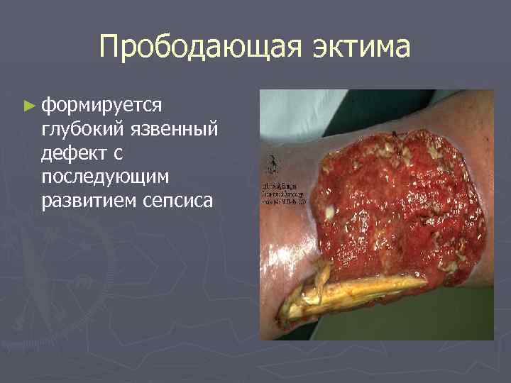 Прободающая эктима ► формируется глубокий язвенный дефект с последующим развитием сепсиса 