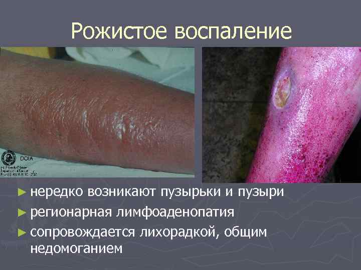 Рожистое воспаление ► нередко возникают пузырьки и пузыри ► регионарная лимфоаденопатия ► сопровождается лихорадкой,