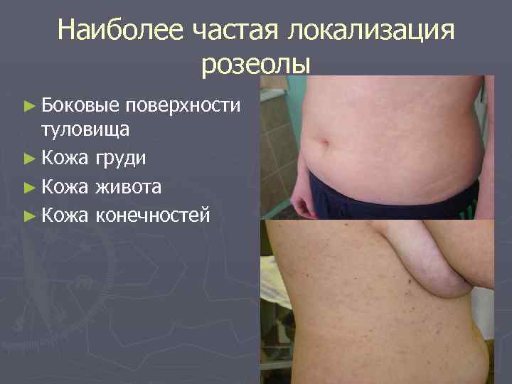 Наиболее частая локализация розеолы ► Боковые поверхности туловища ► Кожа груди ► Кожа живота