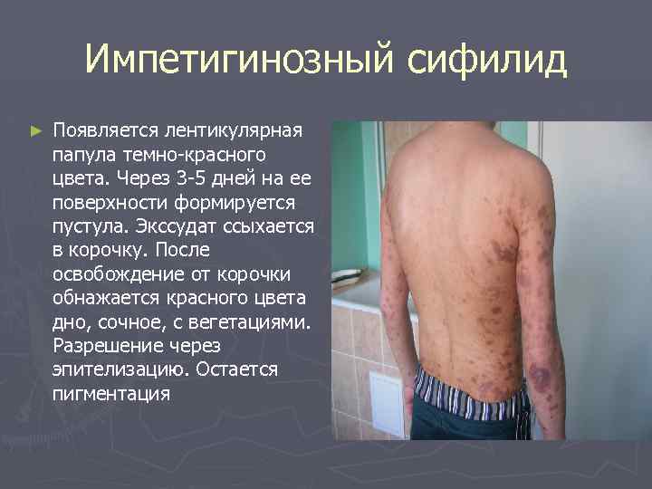 Импетигинозный сифилид ► Появляется лентикулярная папула темно-красного цвета. Через 3 -5 дней на ее