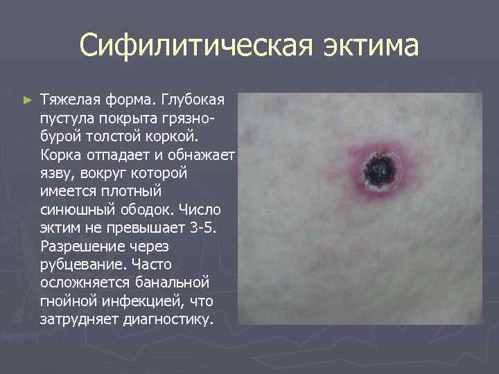 Сифилитическая эктима ► Тяжелая форма. Глубокая пустула покрыта грязнобурой толстой коркой. Корка отпадает и
