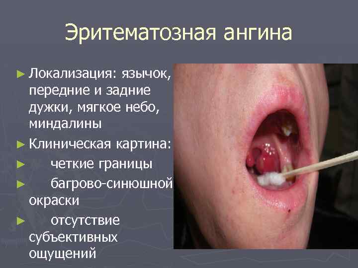 Эритематозная ангина ► Локализация: язычок, передние и задние дужки, мягкое небо, миндалины ► Клиническая