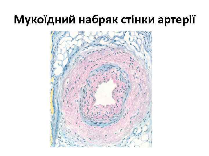 Мукоїдний набряк стінки артерії 