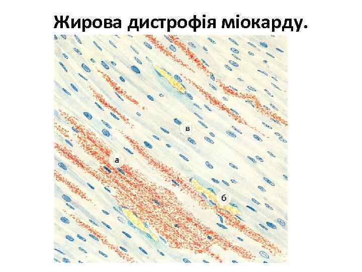 Жирова дистрофія міокарду. 