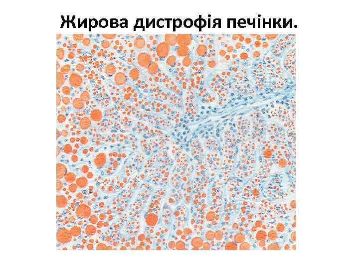 Жирова дистрофія печінки. 
