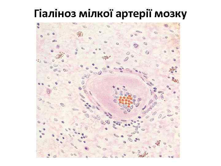 Гіаліноз мілкої артерії мозку 