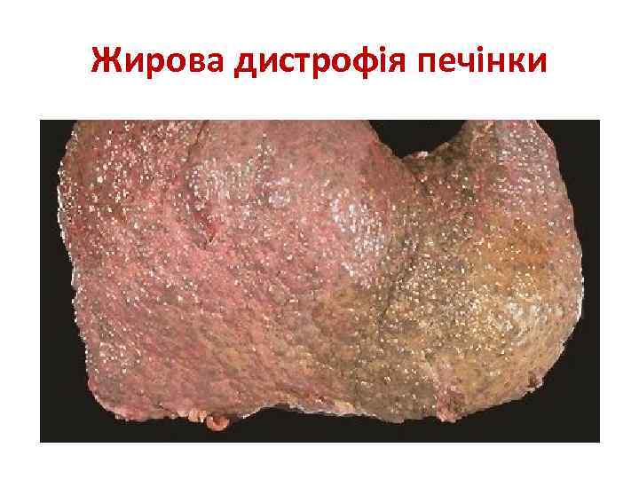 Жирова дистрофія печінки 
