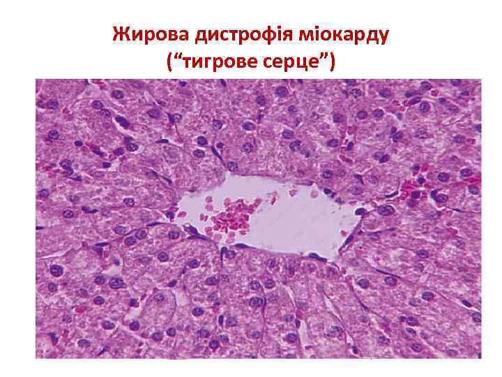 Жирова дистрофія міокарду (“тигрове серце”) 