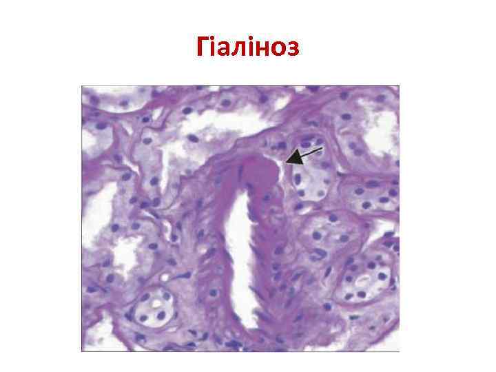 Гіаліноз 